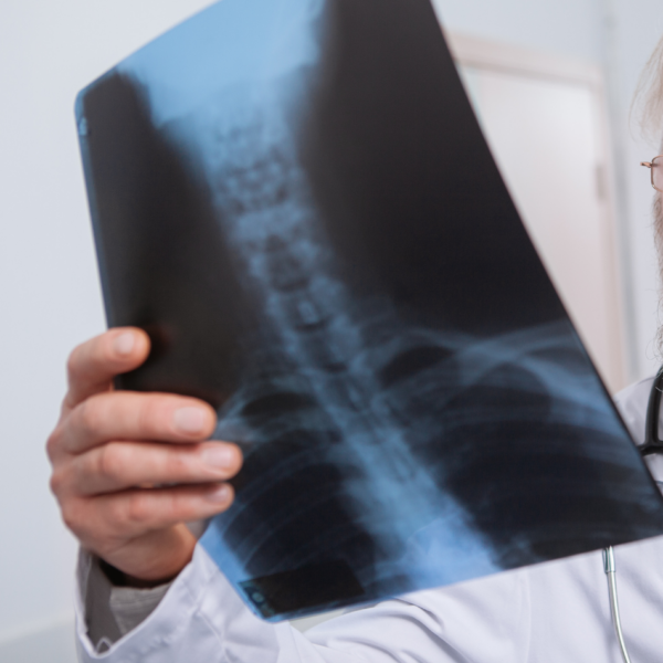 Osteomalacia