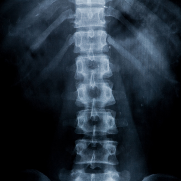 radiografia vertebre