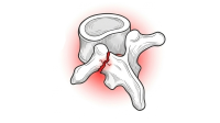 Spondilolisi