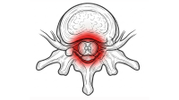 Stenosi spinale
