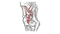 osteomalacia
